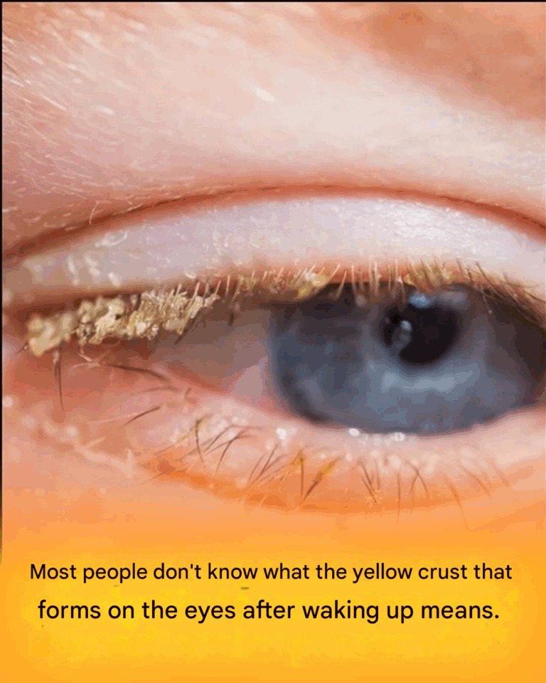 Yellow crust when waking up: what does that mean?
