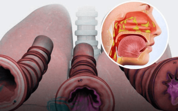 How to Naturally Clear Phlegm and Mucus from Chest and Throat