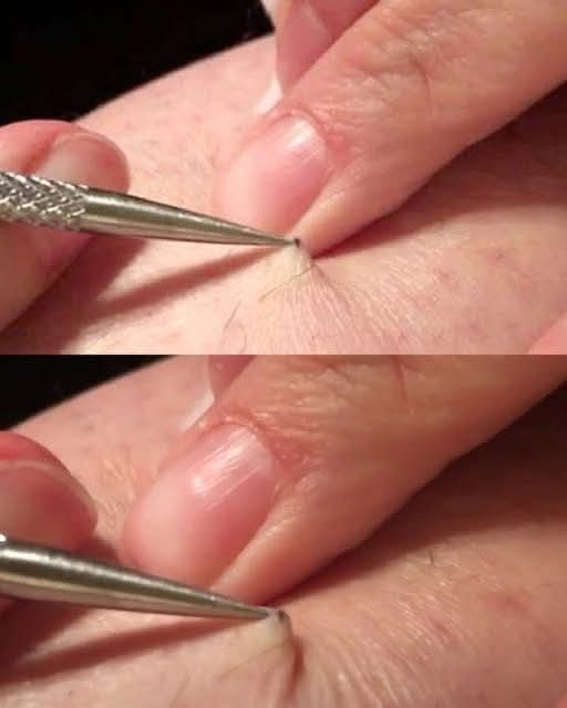 A man discovered a black spot on his leg and began to peel it off. What he removed left millions speechless.